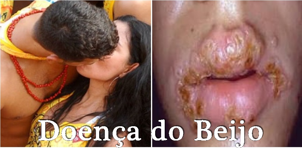 Mononucleose Doenca do beijo