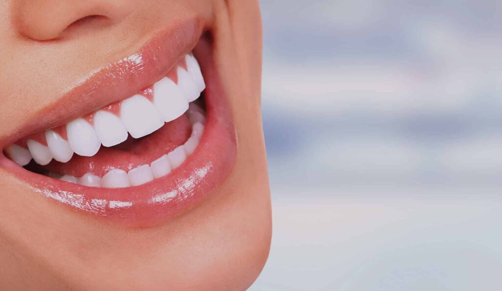 Lente de Contato Dental: Como Funciona, Preços, Vale a Pena? 1 lente de contato dental