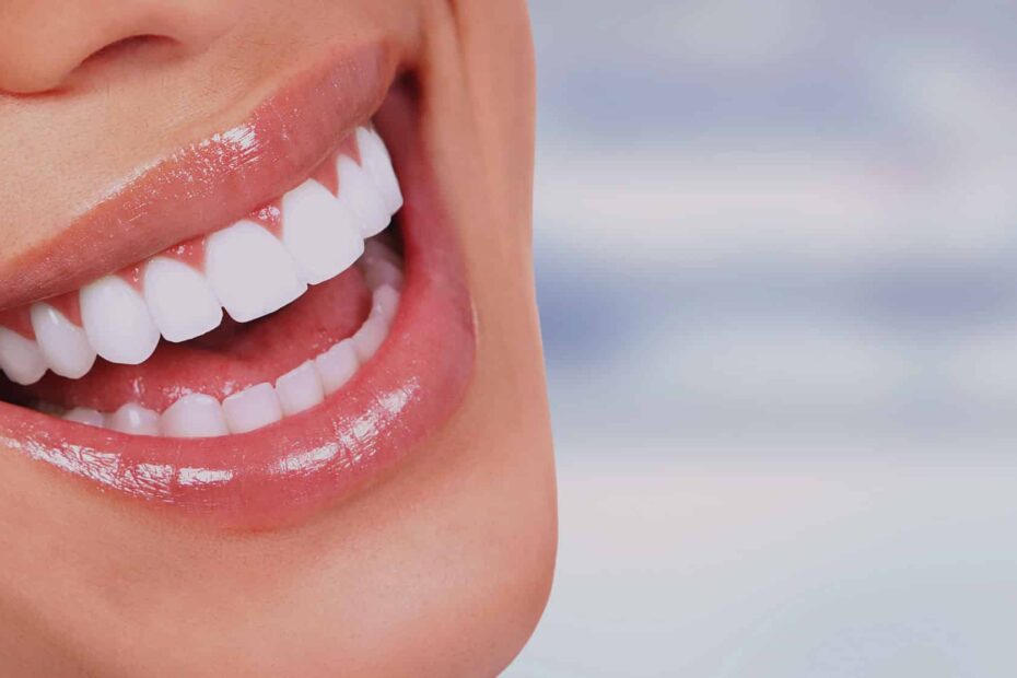 lente de contato dental