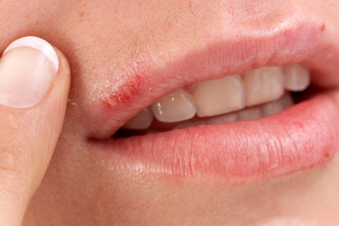 Para Que Serve o Aciclovir: Indicações, Como Usar e Efeitos Colaterais 10 aciclovir