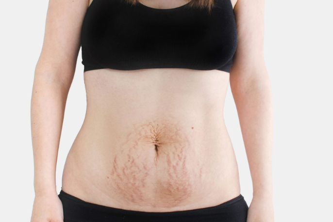 Diástase Abdominal: o que é, sintomas, causas e como tratar 3 diastase abnominal